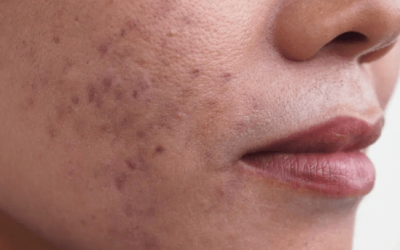 Najčešći uzroci hiperpigmentacija