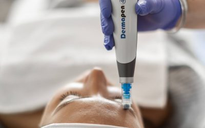 Microneedling tretman: što očekivati i koliko košta