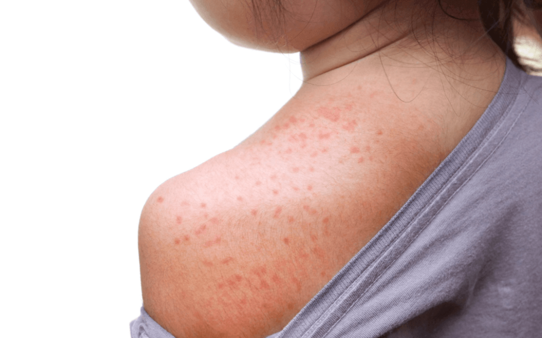 Promjene na koži kod djece: što roditelji trebaju pratiti